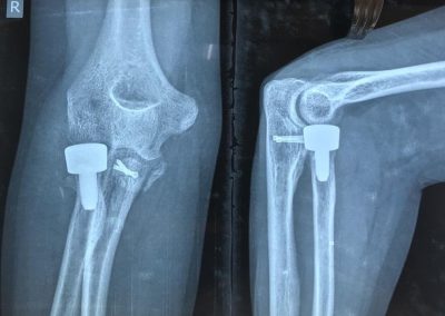 Radial Head Replacement For Elbow Dislocation