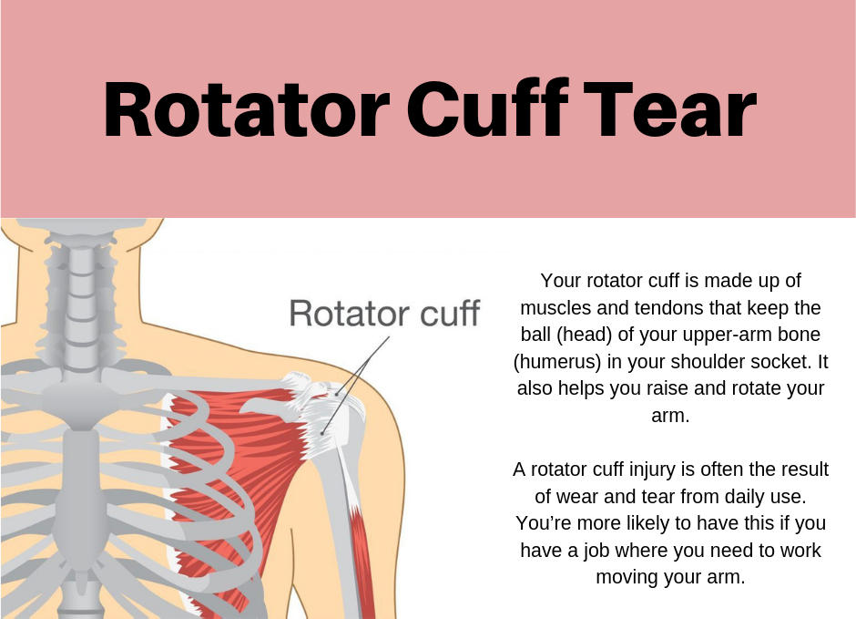 Rotator Cuff Tears- Do I really need an arthroscopic rotator cuff repair?