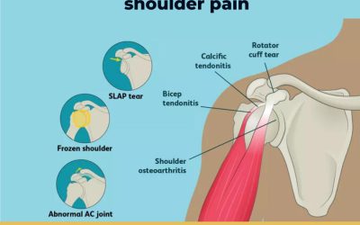 Pinpoint The Cause Of Shoulder Pain