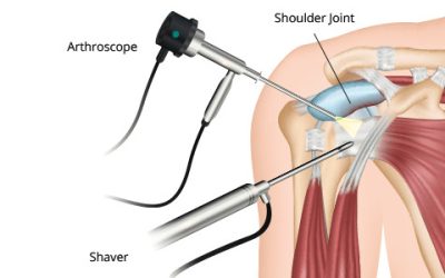 Arthroscopic Shoulder Surgery For The Treatment Of Rotator Cuff Tears – Part2