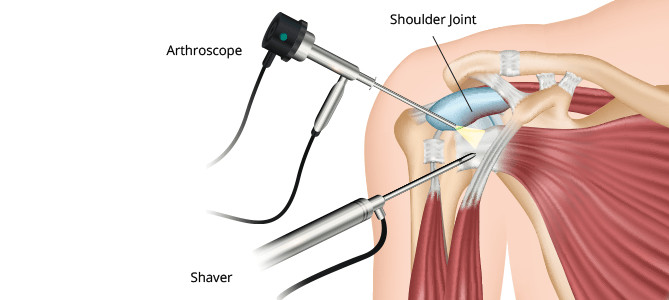 Arthroscopic Shoulder Surgery For The Treatment Of Rotator Cuff Tears – Part2