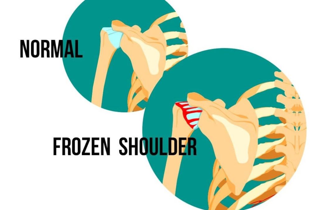 Everything You Needed To Know About Frozen Shoulder
