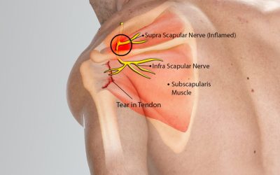 Suprascapular Neuropathy – Cause of Shoulder Pain