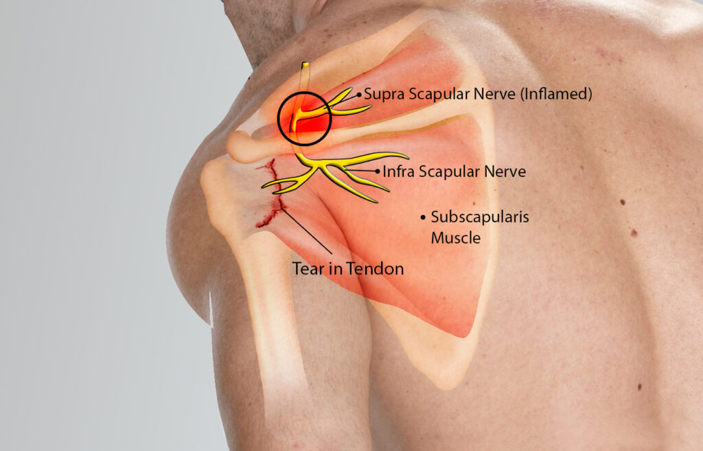 Suprascapular Neuropathy – Cause of Shoulder Pain